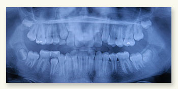 Xray
