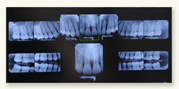 Xray 2